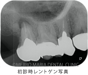 目白マリア歯科【症例】意図的再植術｜歯根破折歯を保存したチャレンジケース_治療前_初診時レントゲン写真
