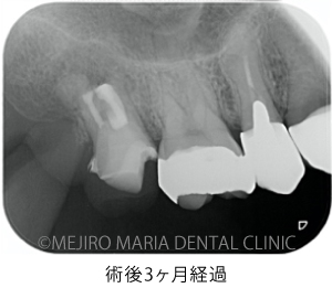 目白マリア歯科【症例】意図的再植術｜歯根破折歯を保存したチャレンジケース_治療後_術後3ヶ月経過したレントゲン写真