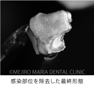 目白マリア歯科【症例】意図的再植術｜歯根破折歯を保存したチャレンジケース_治療詳細_感染部位を除去した最終形態の写真