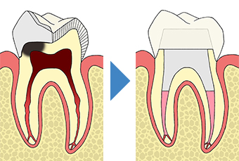 初回根管治療（抜髄）神経をとる治療｜東京 目白の歯医者 目白マリア歯科