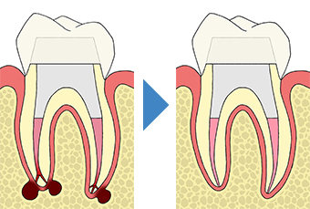 生活歯髄切断法（歯髄保存療法）｜東京 目白の歯医者 目白マリア歯科