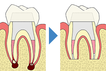 生活歯髄切断法（歯髄保存療法）｜東京 目白の歯医者 目白マリア歯科