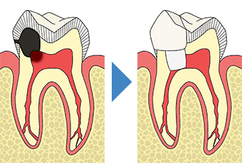 生活歯髄切断法（歯髄保存療法） 神経を残す治療（回復可能な歯髄炎の場合）｜東京 目白の歯医者 目白マリア歯科