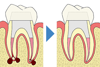感染根管治療 感染した歯髄や腐敗物、細菌を取り除く治療｜東京 目白の歯医者 目白マリア歯科