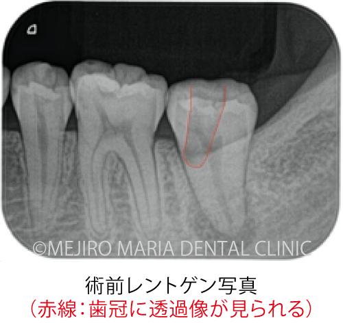 目白マリア歯科_穿孔修復0721治療前3