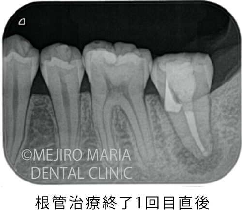 目白マリア歯科_穿孔修復0721治療後1