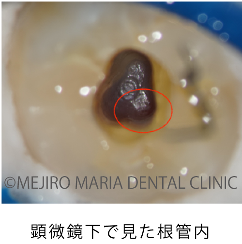 目白マリア歯科_穿孔修復0721治療詳細1
