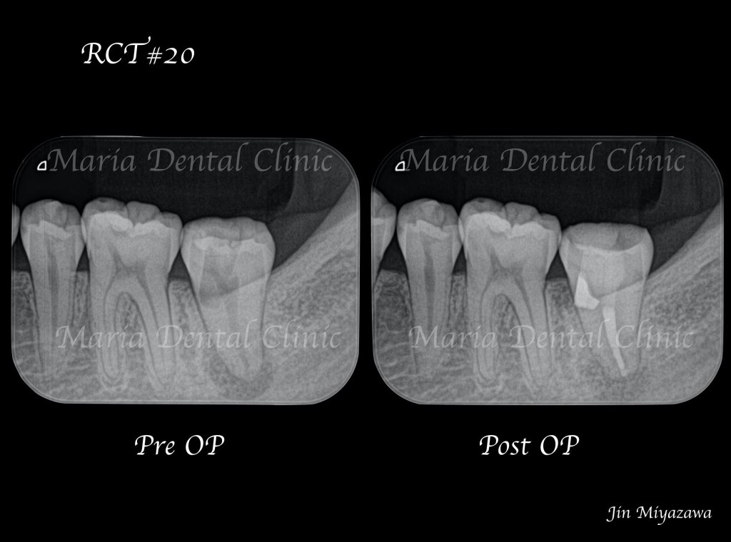 目白マリア歯科【症例】穿孔修復・パーフォレーションリペア｜他院での偶発トラブルに対応したケース_レントゲン写真術前術後