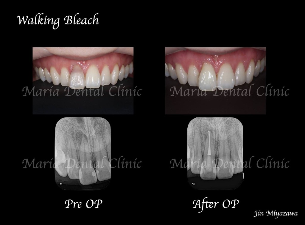 目白マリア歯科【症例】根管治療後のウォーキングブリーチによる審美的回復_Before:After