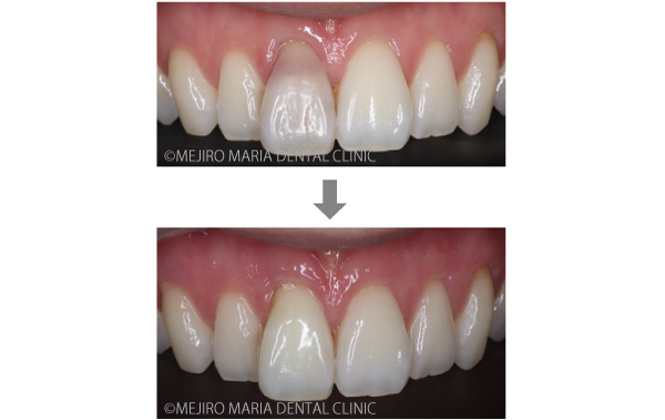 目白マリア歯科【症例】根管治療後のウォーキングブリーチによる審美的回復_メイン_治療前後の比較