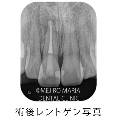 目白マリア歯科【症例】根管治療後のウォーキングブリーチによる審美的回復_治療後_術後レントゲン写真