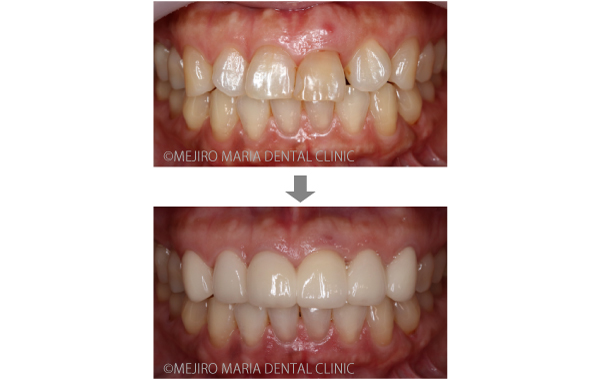 目白マリア歯科【症例】前歯の歯牙保存が不可能なケース①_メイン_治療前後の比較