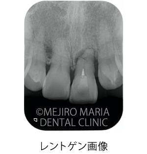 目白マリア歯科【症例】前歯の歯牙保存が不可能なケース①_治療前_レントゲン写真