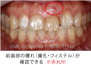 目白マリア歯科【症例】前歯の歯牙保存が不可能なケース①_治療前_前歯部の腫れが確認できる写真