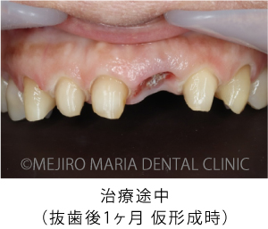 目白マリア歯科【症例】前歯の歯牙保存が不可能なケース①_治療後_治療途中
