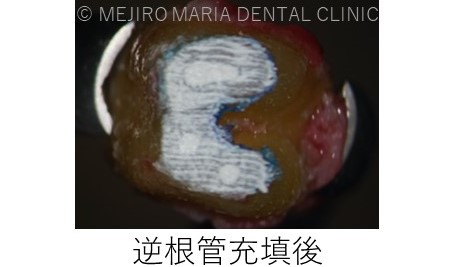 目白マリア歯科【症例】意図的再植_歯根端切除術_治療詳細_抜歯した歯の逆根管充填した画像