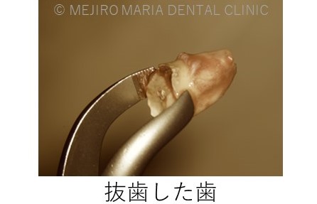 目白マリア歯科【症例】意図的再植_歯根端切除術_治療詳細抜歯した歯の画像