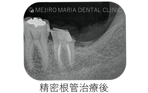 目白マリア歯科【症例】意図的再植_歯根端切除術_精密根管治療後レントゲン画像