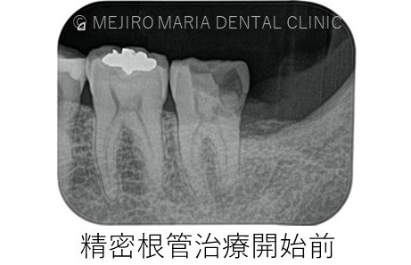 目白マリア歯科【症例】意図的再植_歯根端切除術_精密根管治療開始前レントゲン画像