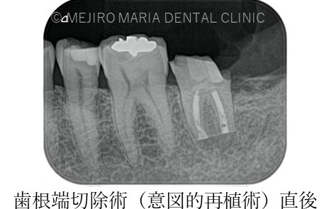目白マリア歯科【症例】意図的再植_歯根端切除術直後のレントゲン画像