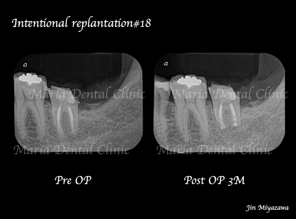目白マリア歯科【症例】根管治療後も症状の改善が認められないケース・意図的再植・歯根端切除術レントゲン画像術前術後