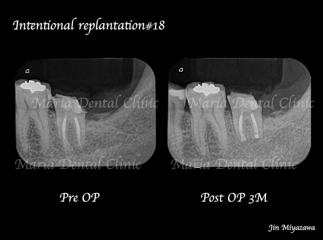 目白マリア歯科【症例】根管治療後も症状の改善が認められないケース・意図的再植・歯根端切除術レントゲン画像術前術後