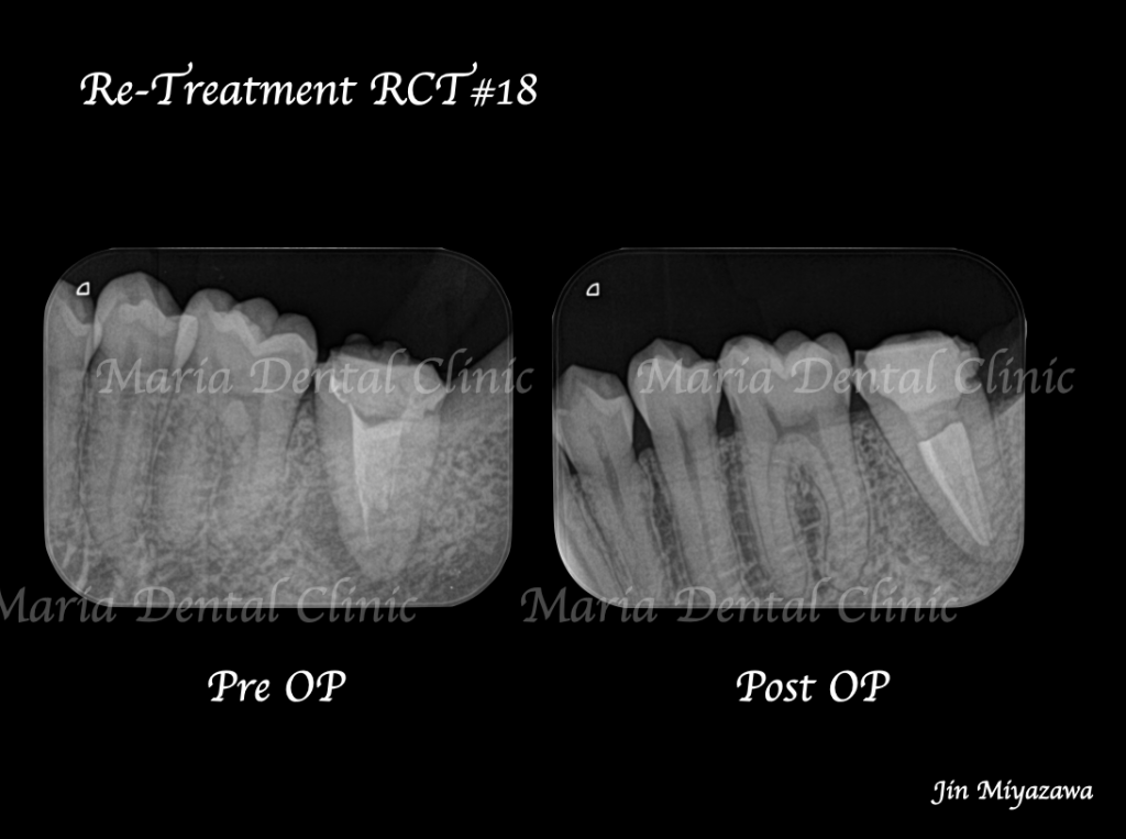 【症例】複雑な歯根形態「樋状根」（といじょうこん）に対する、精密根管治療のアプローチ（再根管治療）｜歯質を守る精密な根管治療_術前術後のレントゲン画像比較