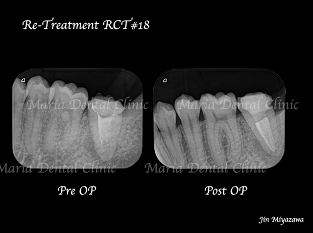 目白マリア歯科【症例】複雑な歯根形態（樋状根 （といじょうこん））に対する、精密根管治療のアプローチ（再根管治療）の治療前治療後のレントゲン画像