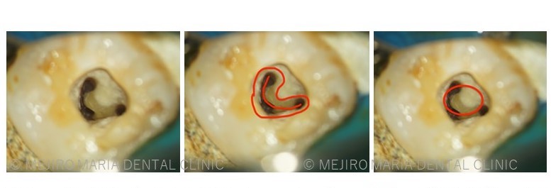 目白マリア歯科【症例】複雑な歯根形態「樋状根」（といじょうこん）に対する、精密根管治療のアプローチ（再根管治療）_「樋状根」の説明画像