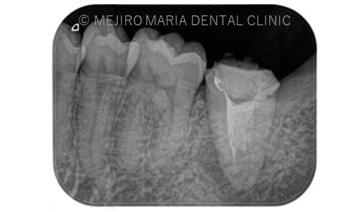 目白マリア歯科【症例】複雑な歯根形態「樋状根」（といじょうこん）に対する、精密根管治療のアプローチ（再根管治療）_治療前のレントゲン画像1