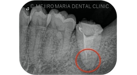 目白マリア歯科【症例】複雑な歯根形態「樋状根」（といじょうこん）に対する、精密根管治療のアプローチ（再根管治療）_治療前のレントゲン画像２