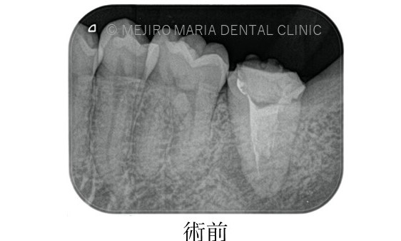 目白マリア歯科【症例】複雑な歯根形態「樋状根」（といじょうこん）に対する、精密根管治療のアプローチ（再根管治療）_治療前後比較治療前のレントゲン画像