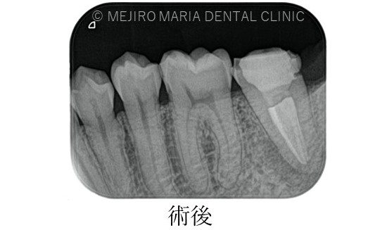目白マリア歯科【症例】複雑な歯根形態「樋状根」（といじょうこん）に対する、精密根管治療のアプローチ（再根管治療）_治療前後比較治療後のレントゲン画像