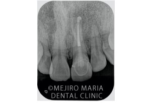 目白マリア歯科_【症例】前歯のセラミック修復による審美的な回復（前歯部１歯補綴）_RCF（根幹補充）後のX線写真