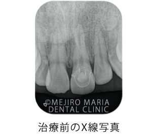 目白マリア歯科_【症例】前歯のセラミック修復による審美的な回復（前歯部１歯補綴）_初診時のX線写真
