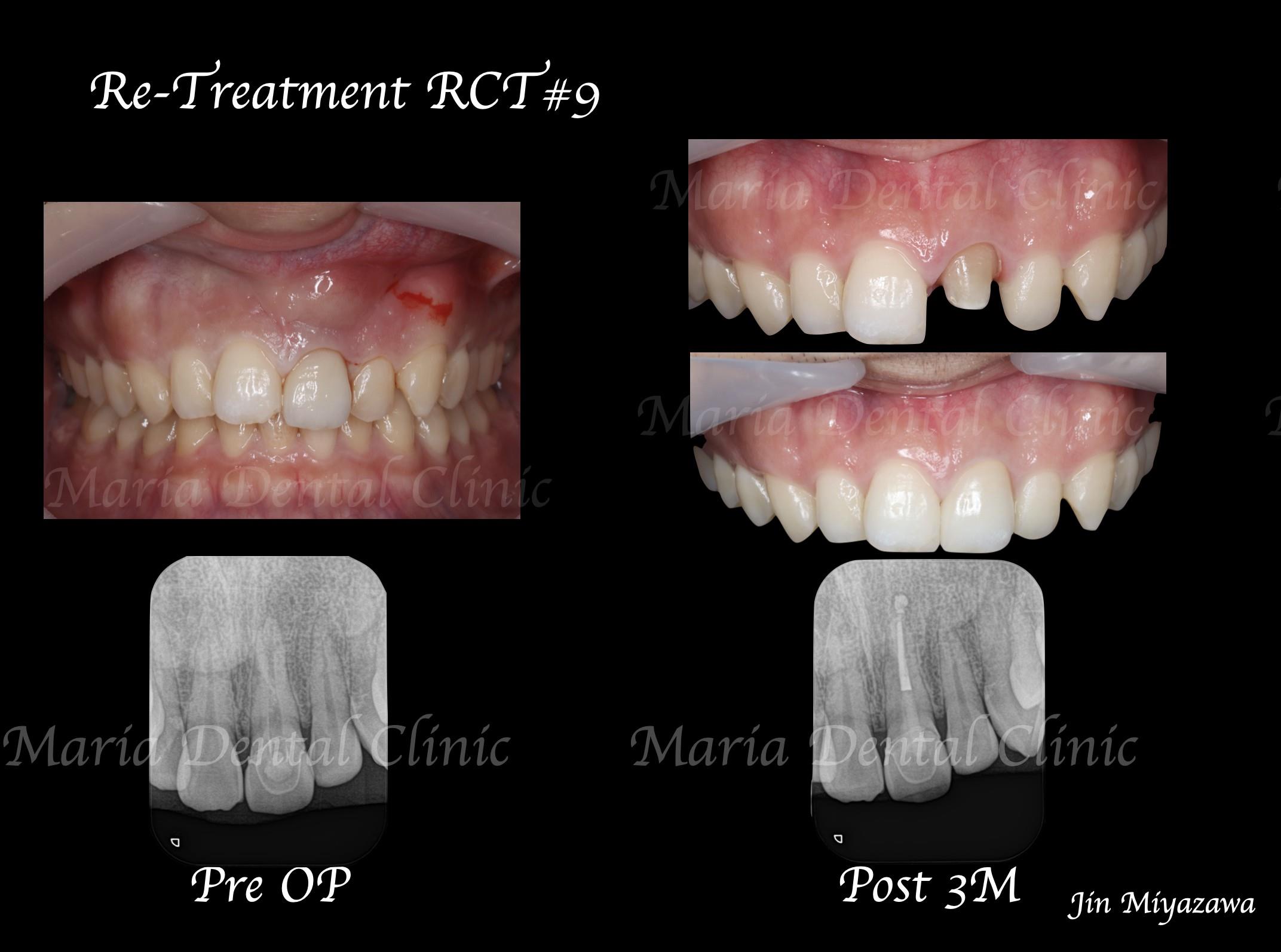 目白マリア歯科_【症例】前歯のセラミック修復による審美的な回復（前歯部１歯補綴）_口腔内及X線の比較写真
