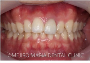 目白マリア歯科_【症例】前歯のセラミック修復による審美的な回復（前歯部１歯補綴）_根管治療終了後の口腔内写真