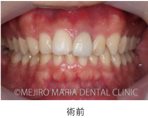 目白マリア歯科_【症例】前歯のセラミック修復による審美的な回復（前歯部１歯補綴）_術前の口腔内写真