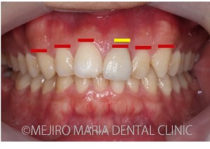 目白マリア歯科_【症例】前歯のセラミック修復による審美的な回復（前歯部１歯補綴）_（※）歯肉ラインの口腔内写真-2