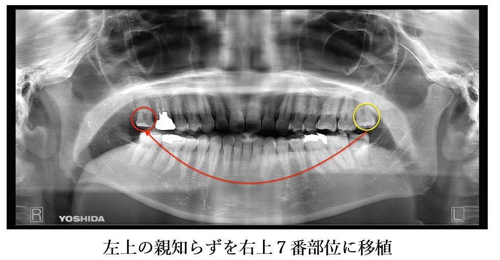 目白マリア歯科 親知らずの移植でインプラントを回避した症例_パノラマX線画像左上親知らずを右上7番部位に移植