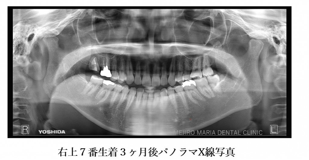 目白マリア歯科 親知らずの移植でインプラントを回避した症例_根生着後3ヶ月パノラマX線画像