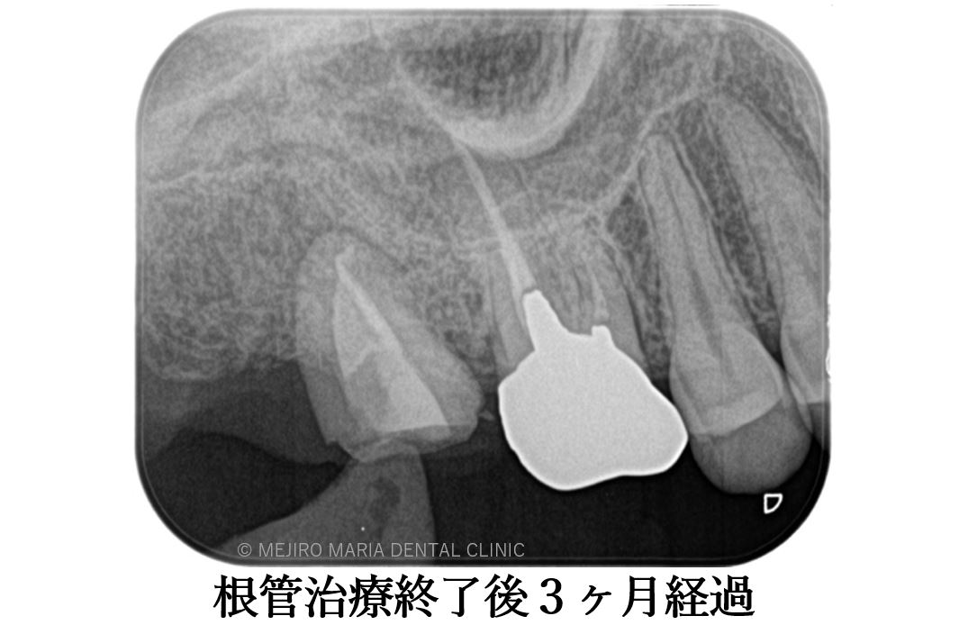 目白マリア歯科 親知らずの移植でインプラントを回避した症例_根管治療後3か月のレントゲン画像