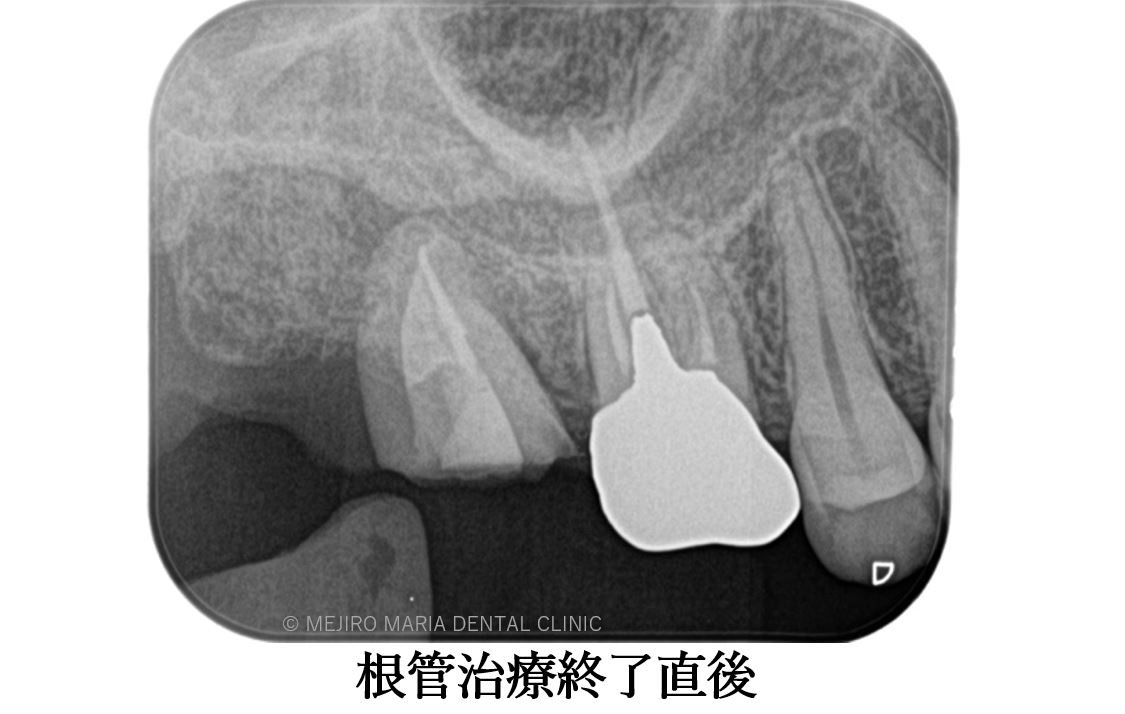目白マリア歯科 親知らずの移植でインプラントを回避した症例_根管治療直後レントゲン画像