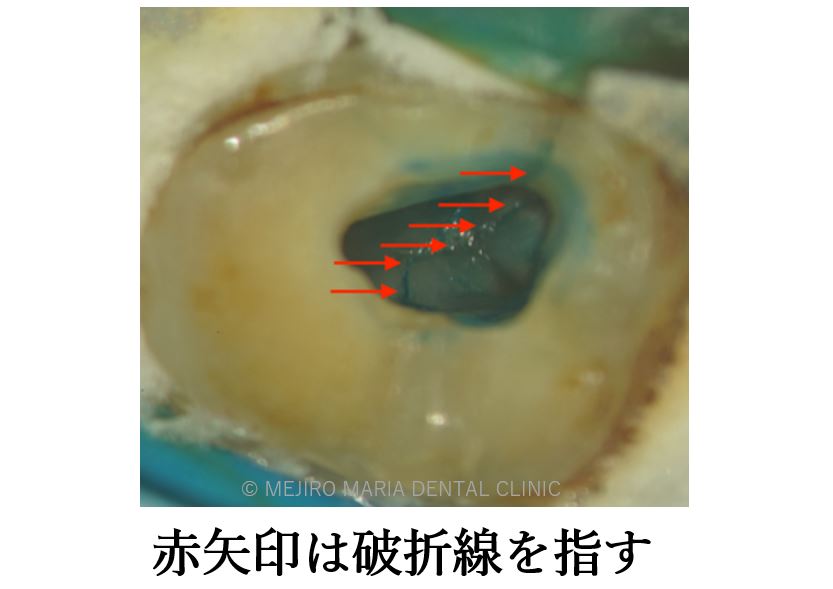 目白マリア歯科 親知らずの移植でインプラントを回避した症例_治療中画像歯根破折線