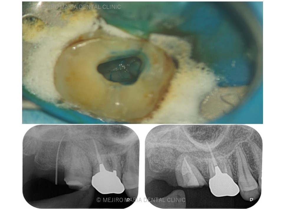目白マリア歯科 親知らずの移植でインプラントを回避した症例レントゲン画像