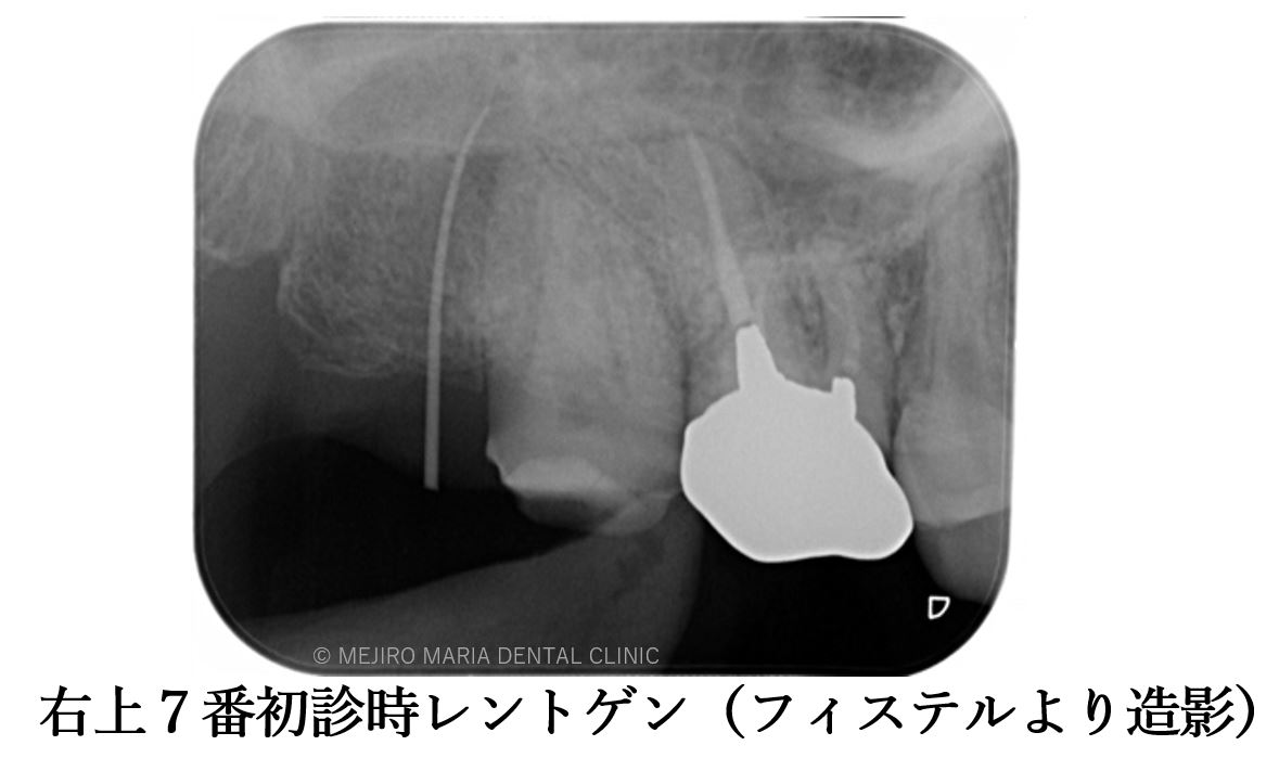 目白マリア歯科 親知らずの移植でインプラントを回避した症例初診時レントゲン画像フィステルより造影