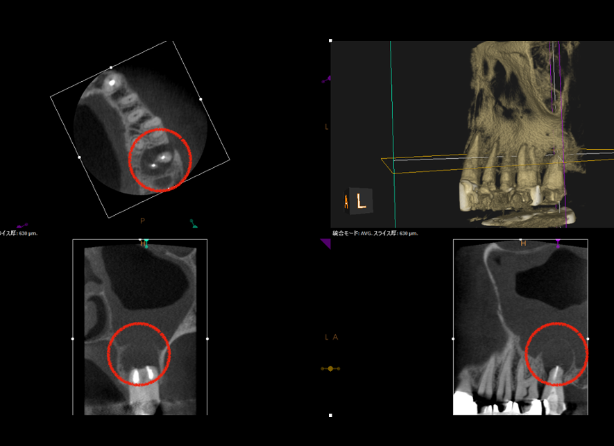 目白マリア歯科｜【症例】歯根端切除術（意図的再植術）により、病変の大きい根尖性歯周炎の抜歯を回避｜治療詳細_術前-CT画像
