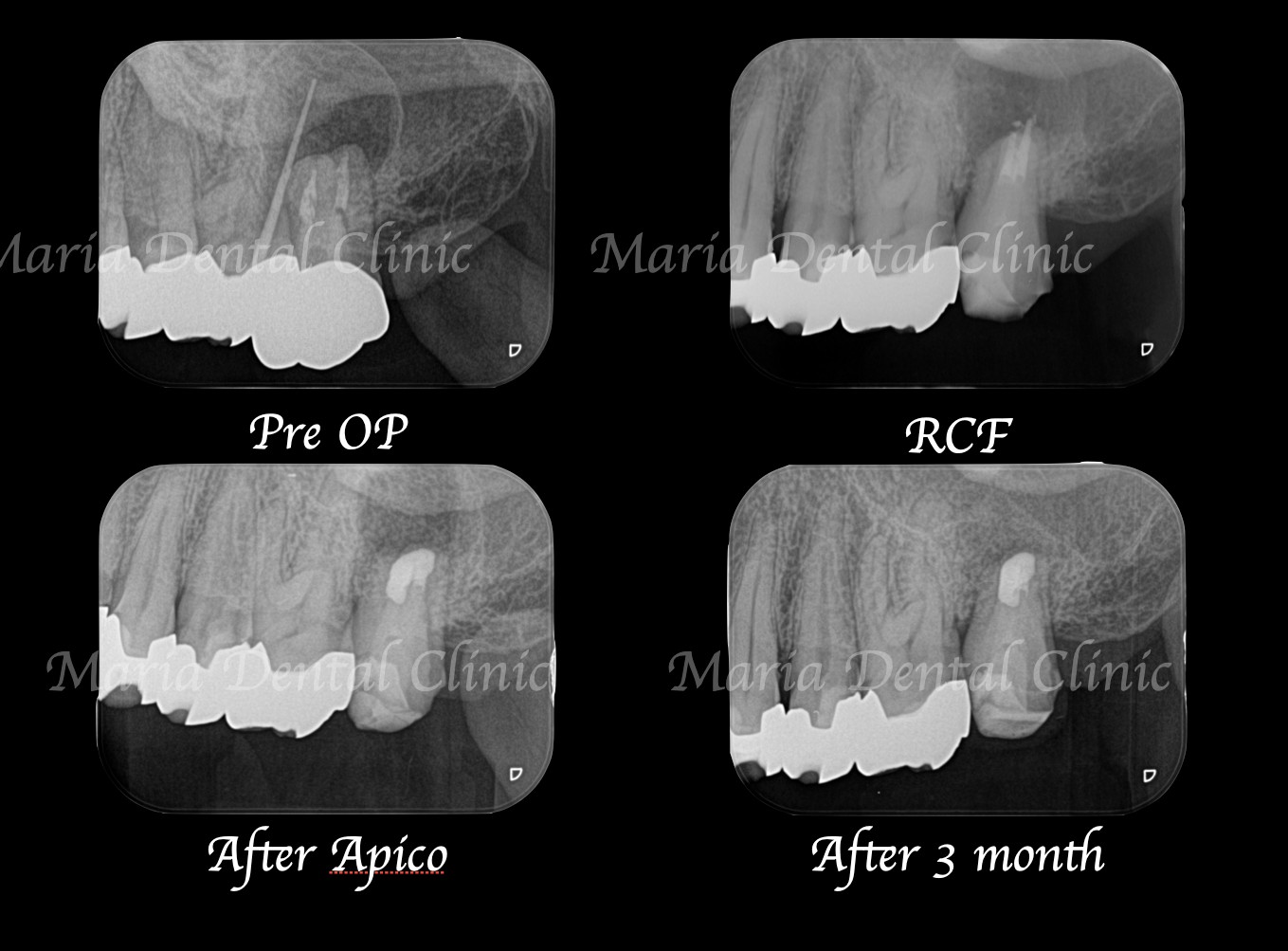 目白マリア歯科｜【症例】歯根端切除術（意図的再植術）により、病変の大きい根尖性歯周炎の抜歯を回避｜レントゲンの比較画像