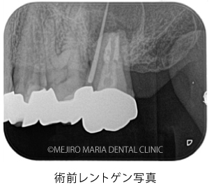 目白マリア歯科｜【症例】歯根端切除術（意図的再植術）により、病変の大きい根尖性歯周炎の抜歯を回避｜治療前_術前レントゲン写真