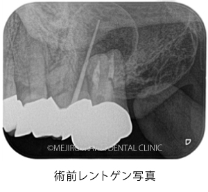 目白マリア歯科｜【症例】歯根端切除術（意図的再植術）により、病変の大きい根尖性歯周炎の抜歯を回避｜治療前_術前レントゲン写真2